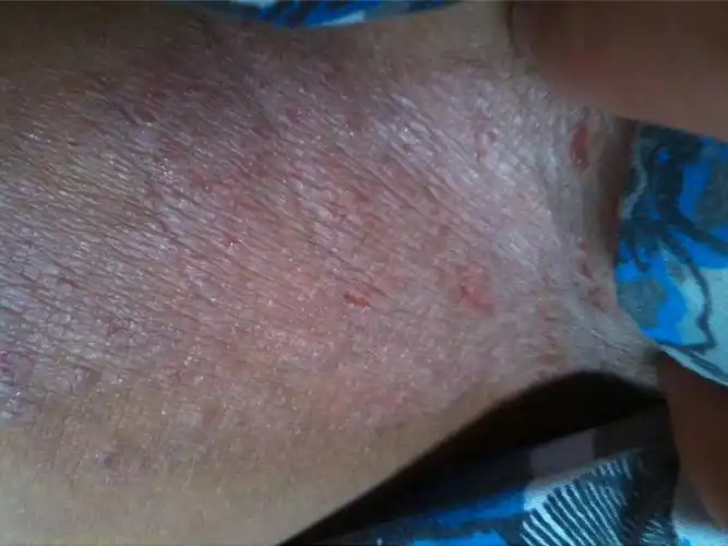 2014-06-24 李振大 医师 睾丸肿大疼痛,右睾丸旁边有根肿大的筋,好几