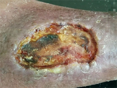 坏死组织,皮损干燥,有细微碎屑附着,同时皮损周围有一圈苍白的皮肤,外