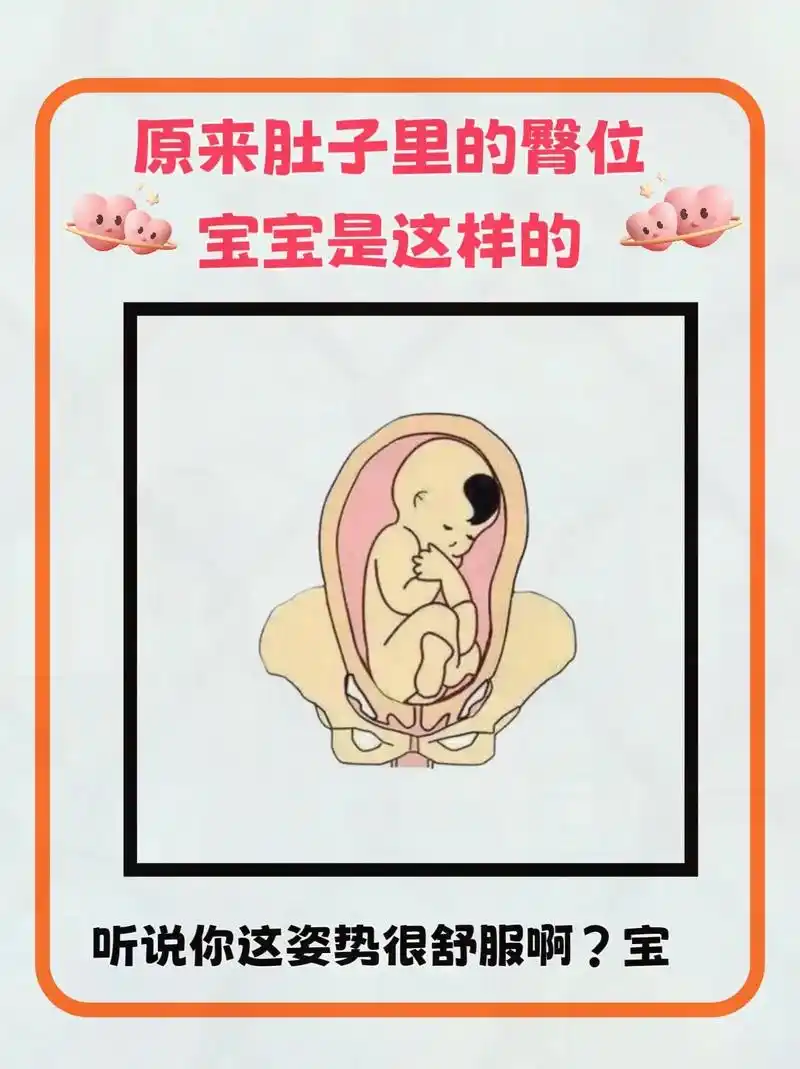 原来臀位的宝宝是这样的,舒服的都不愿意转过来!#胎宝宝在肚子 - 抖音