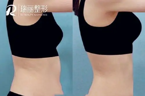 哈尔滨瑞丽腰腹吸脂前后对比
