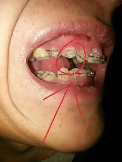 在私人诊所正畸被拔了四颗牙,还有上面两个虎牙尖被下牙托槽还有的