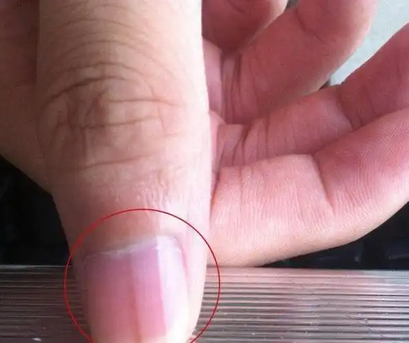 指甲出现"竖纹",与什么因素有关?该如何改善?建议了解