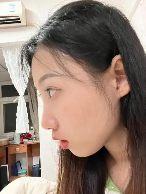 小时候鼻炎一直口呼吸,颧骨高下巴后缩怎么办 侧面拍照真的很丑 急求
