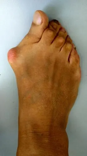 拇外翻患者手术前后对比 - 好大夫在线