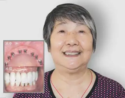 55岁黄阿姨做半口种植牙 期待笑口常开_我的网站