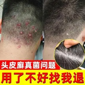 头皮真菌感染药膏