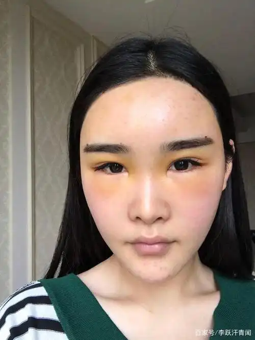 额头填充脂肪过多量饱满修复术后4个月分享