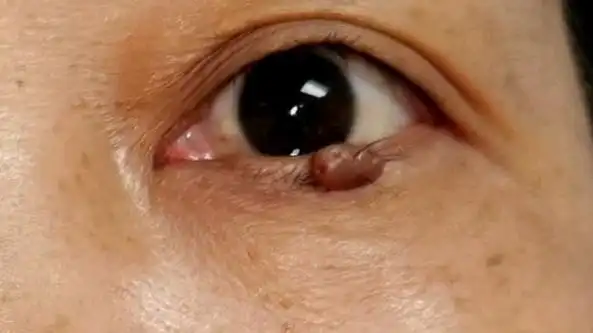 活动  去痣也讲究技术--这么大的睑缘痣,切得一点痕迹都没有