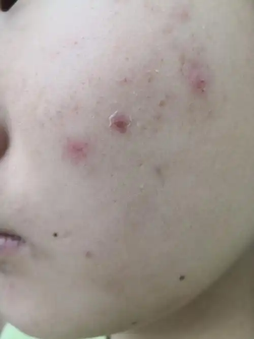 解决皮肤问题专注皮肤美容##痤疮##毛囊炎