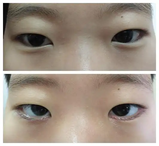 先天性眼睑内翻,倒睫手术