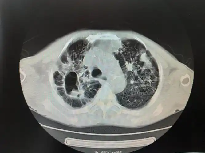 胸部ct双肺继发性肺结核,右上肺空洞形成.