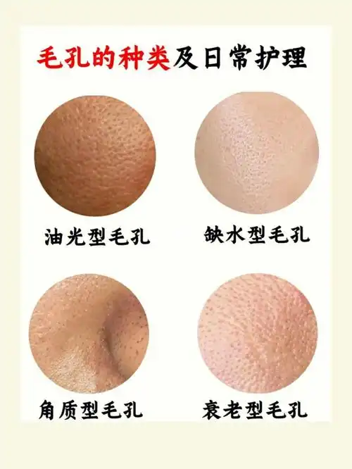 毛孔粗大怎么办78分清毛孔类型