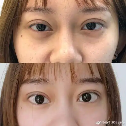 双眼皮宽改窄术后一周