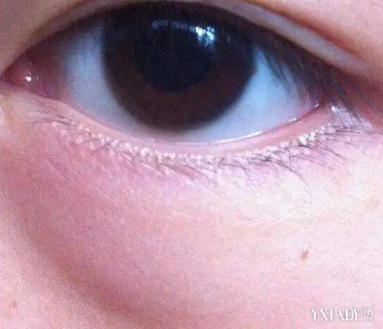 图下眼袋肿大怎么回事解决方案告诉你