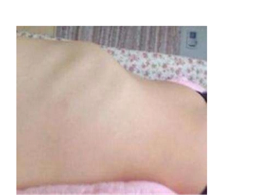 鸡胸问答_鸡胸患者咨询-有来医生