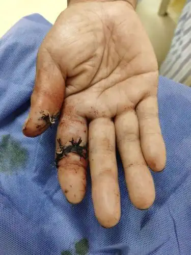 断肢再植是将手指完全离断的情况下,在光学显微镜的助视下,将断离的