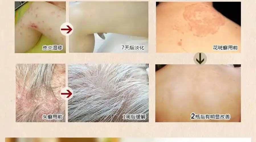 皮炎和皮廯的区别图片