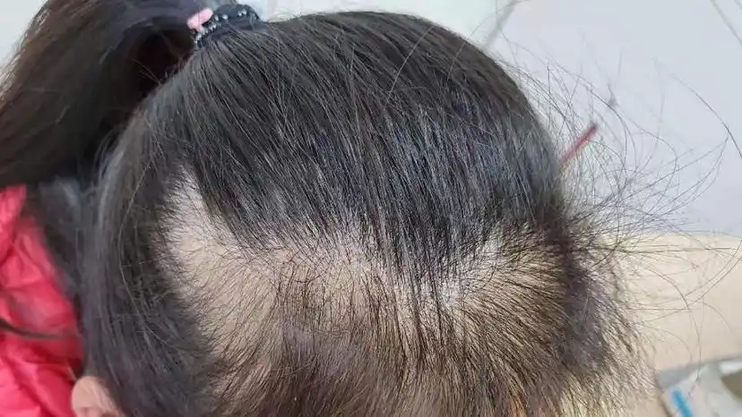 儿童脱发小心拔毛癖