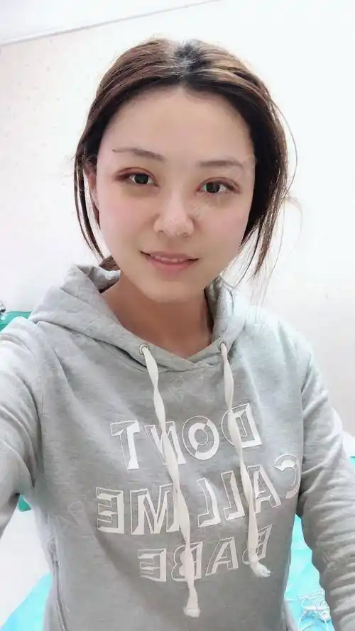 终于拆线了,可能我是修复的,所以恢复期会比别人稍微久一点,眼睛还是