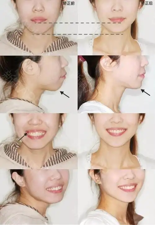 ▌ 矫正前后面像对比