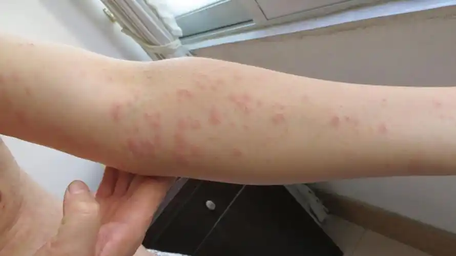 全身和四肢都起了红点,这是什么病?怎么治?