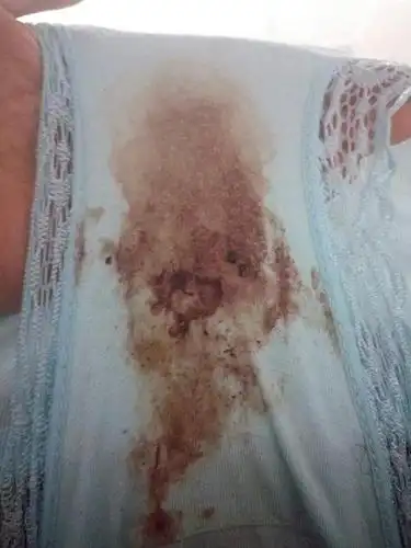 连续半个月白带带血,有时候头晕,有图,慎入