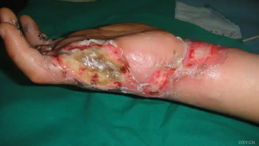 【讨论】13岁女孩,右手电烧伤,如何修复创面最好? [病例帖]