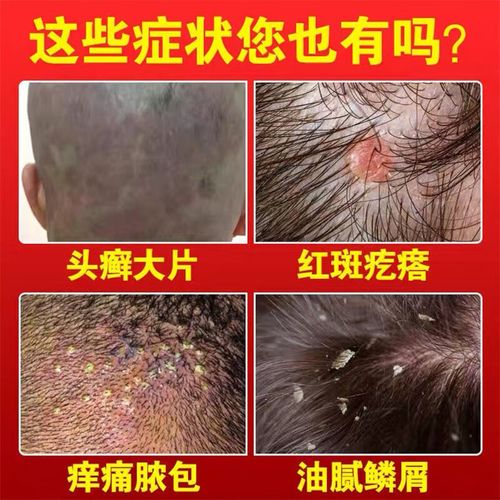 脂溢性皮炎毛囊丨炎洗发水去屑止丨痒治疗头部头皮痒有疙瘩专用洗 单