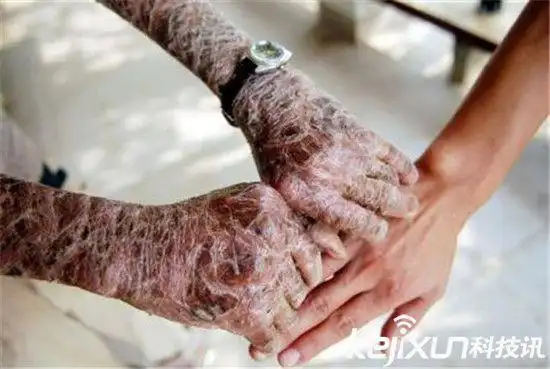 男子全身长满鱼鳞靠疼痛止痒从小被看成怪物孤立无援