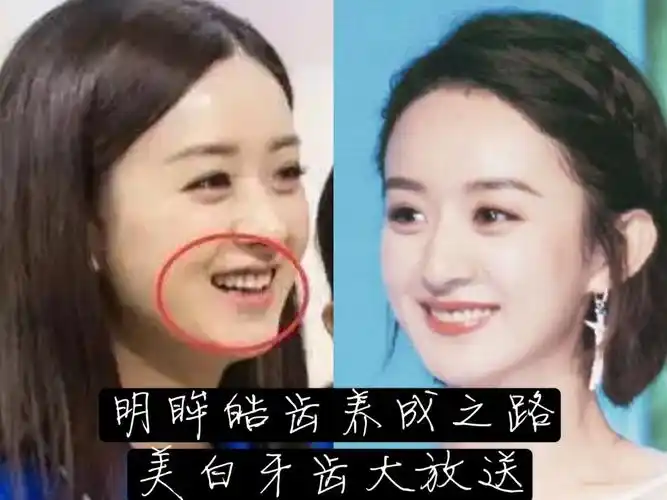 成为明眸皓齿的美人复出之后的赵丽颖状_圈子-新氧美容整形