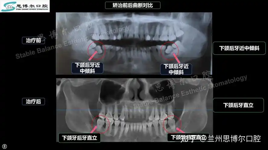 下颌双侧第二磨牙近中倾斜矫治案例 - 知乎