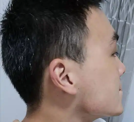 下颌骨很难看啊,是咬肌大还是骨头问题或者是肉多了?