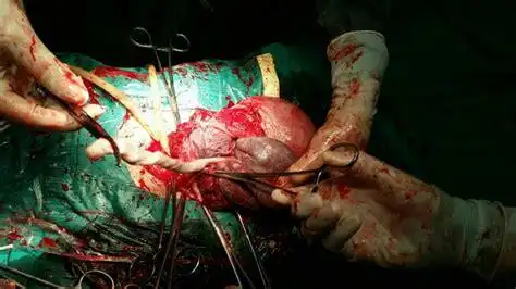 胎盘内血池变大了