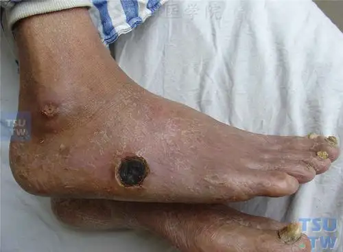 闭塞型动脉硬化症的症状表现 - 皮肤病诊断图谱 - 天山医学院