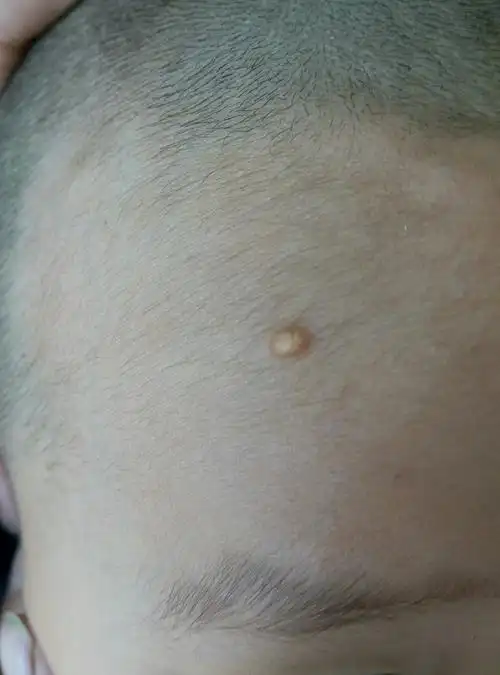 幼年黄色肉芽肿是怎么回事