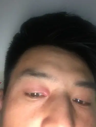 眼镜最近长了一个囊肿,有点疼开始是整个眼皮肿现在成这样了是什么
