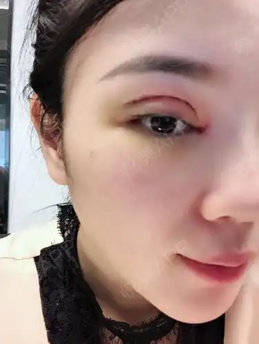 今天是我做双眼皮的第十天最近事情比较多很久没来更新了呢多亏了更美