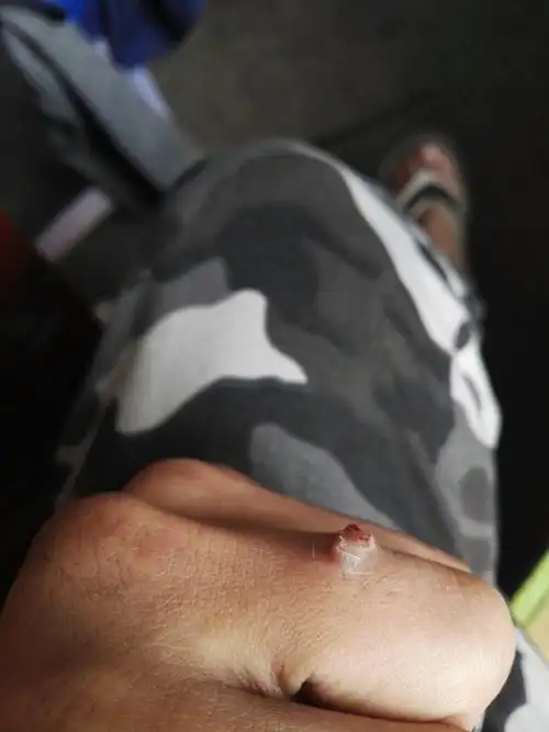 手指上长了一个肉瘤一样的东西,摸了会痛,这是什么啊