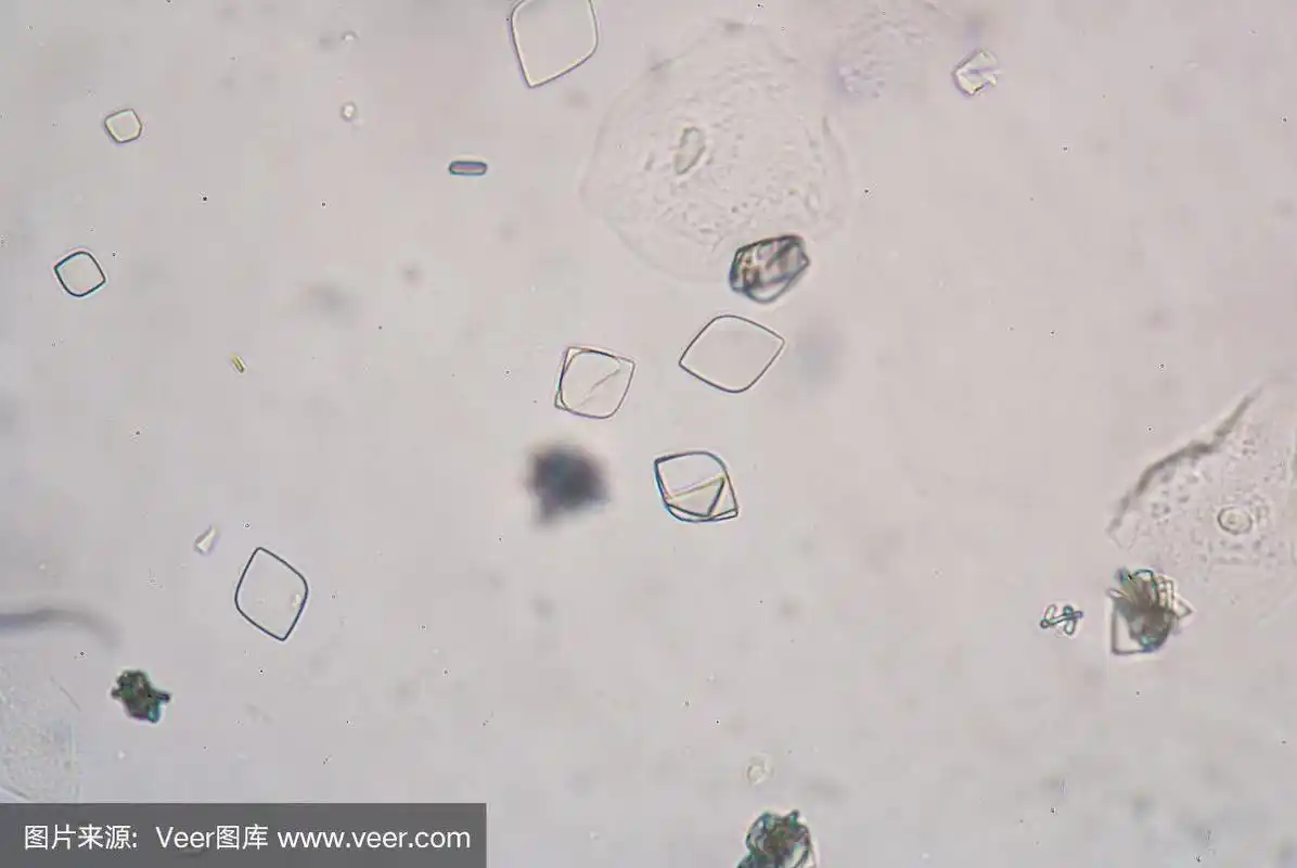 尿中的尿酸结晶.