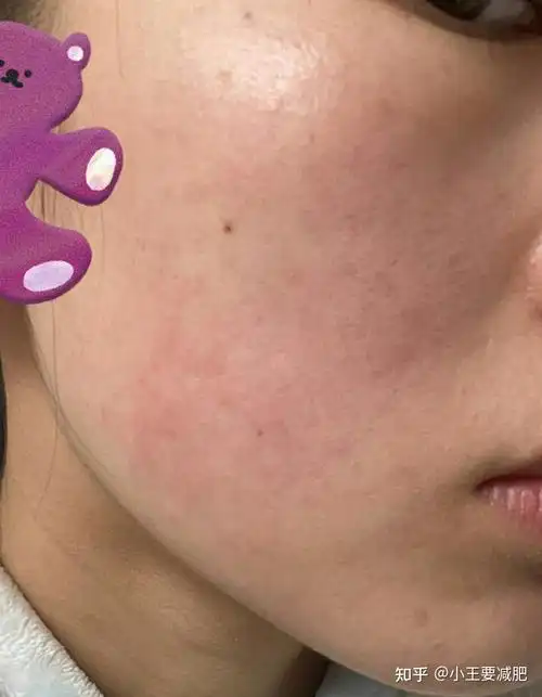 皮肤屏障受损怎么修复屏障受损应该怎么做