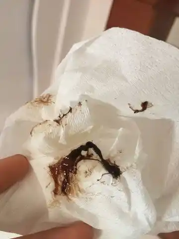 怀孕11周 3天,流黑色粘稠血块,是积血吗?