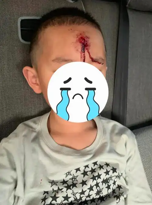 爸爸带俩娃去爬山下午5点多,爸爸打电话说,老二摔了一跤 ,把头磕破了