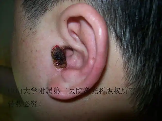 我用激光做的耳屏黑毛痣,手艺还不错吧! - 好大夫在线