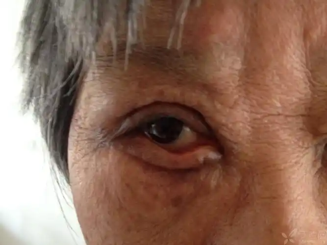 2014-04-08 22:57   关注      70岁老人,由于他院下眼睑倒睫手术失败