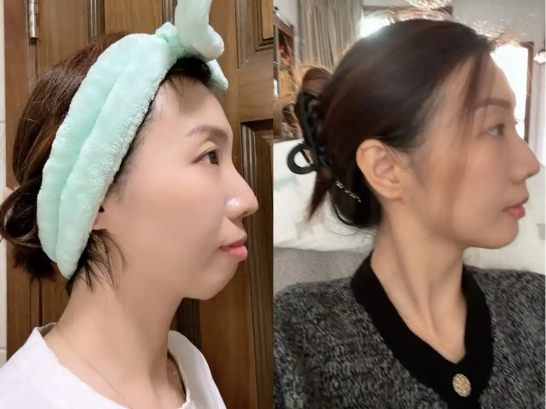 后悔没有早点去整牙!对比下侧脸变化.骨性凸嘴,35岁开始带牙 - 抖音