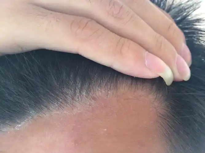 每次洗完头头皮上都会出现一层头皮