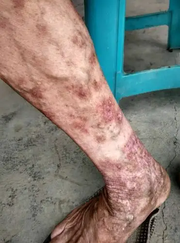 经方治疗顽固性湿疹好转图片 - 好大夫在线