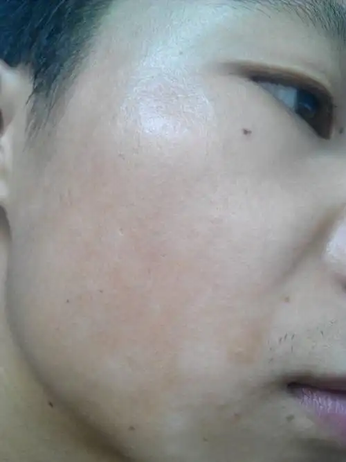 脸上长了好多白斑,手指左右大的,有好几年了,以前都没在意过,好像有点