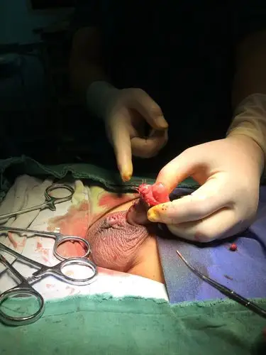 包皮过长合并蹼状阴茎一例_腹侧