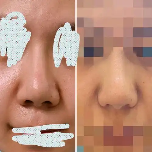 只do了缩鼻翼没有鼻头